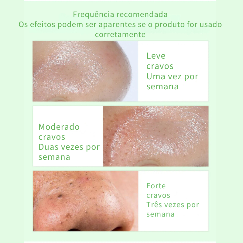 Sérum Removedor de Cravos e Acnes com Aloe Vera